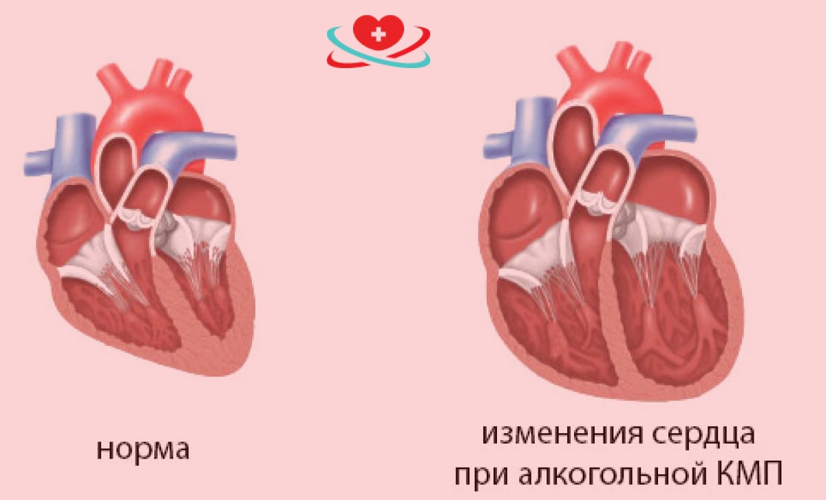 Кардиопатия сердца что это у взрослого. Сердечной недостаточности кардиомиопатии. Алкогольная дилатационная кардиомиопатия. Алкогольная кардиомиопатия сердца. Дилатационная кардиомиопатия + алкоголь.